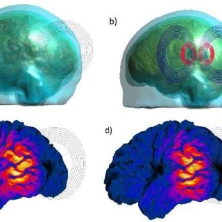 MRI-based simulation of TMS fields